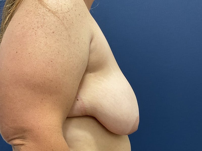Breast Lift by Dr. Booth Before & After Gallery - Patient 192738 - Image 5