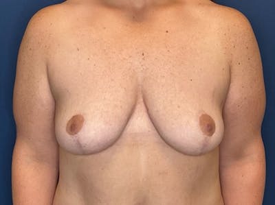 Breast Reduction by Dr. Booth Before & After Gallery - Patient 266832 - Image 2