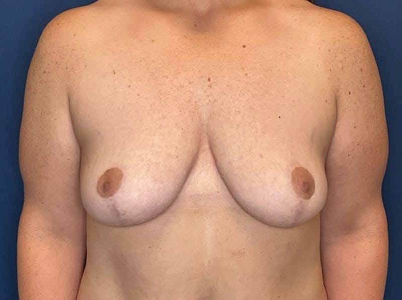 Breast Reduction by Dr. Booth Before & After Gallery - Patient 266832 - Image 2