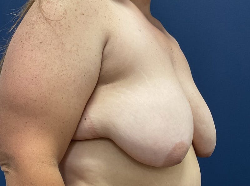 Breast Reduction by Dr. Booth Before & After Gallery - Patient 266832 - Image 3