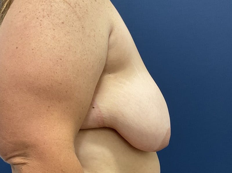 Breast Reduction by Dr. Booth Before & After Gallery - Patient 266832 - Image 5