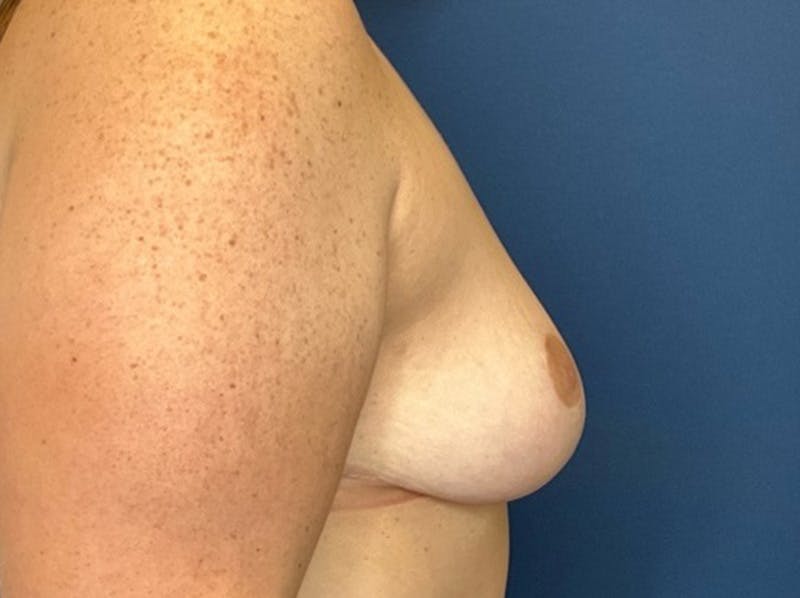 Breast Reduction by Dr. Booth Before & After Gallery - Patient 266832 - Image 6
