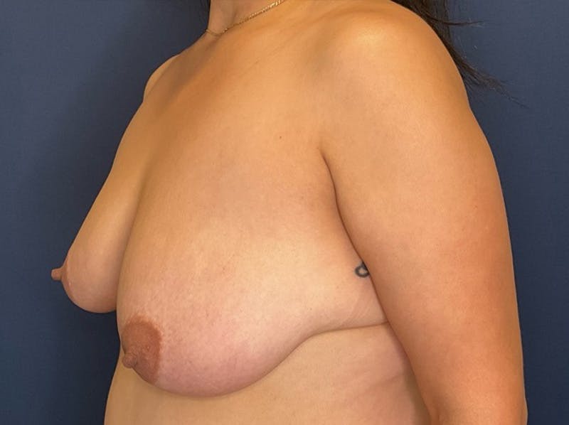 Breast Reduction by Dr. Booth Before & After Gallery - Patient 893069 - Image 7