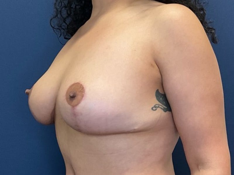 Breast Reduction by Dr. Booth Before & After Gallery - Patient 893069 - Image 8
