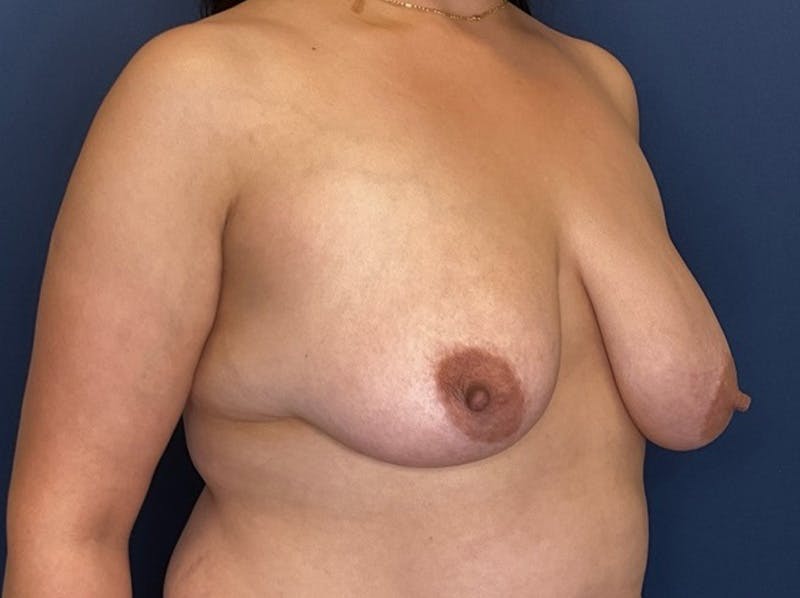 Breast Reduction by Dr. Booth Before & After Gallery - Patient 893069 - Image 3