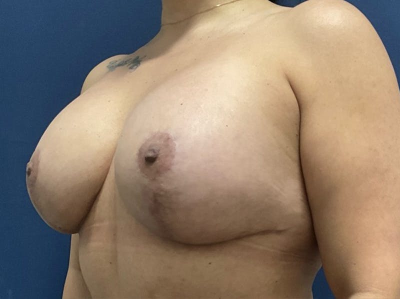 Implant Exchange by Dr. Booth Before & After Gallery - Patient 158193 - Image 6