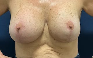 Breast Lift with Implant Exchange Dr. Booth Before & After Gallery - Patient 241869 - Image 2
