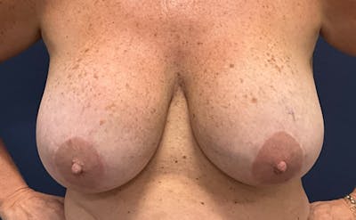 Breast Lift with Implant Exchange Dr. Booth Before & After Gallery - Patient 241869 - Image 1