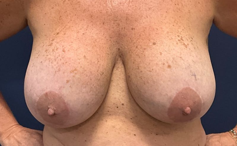 Breast Lift with Implant Exchange Dr. Booth Before & After Gallery - Patient 241869 - Image 1