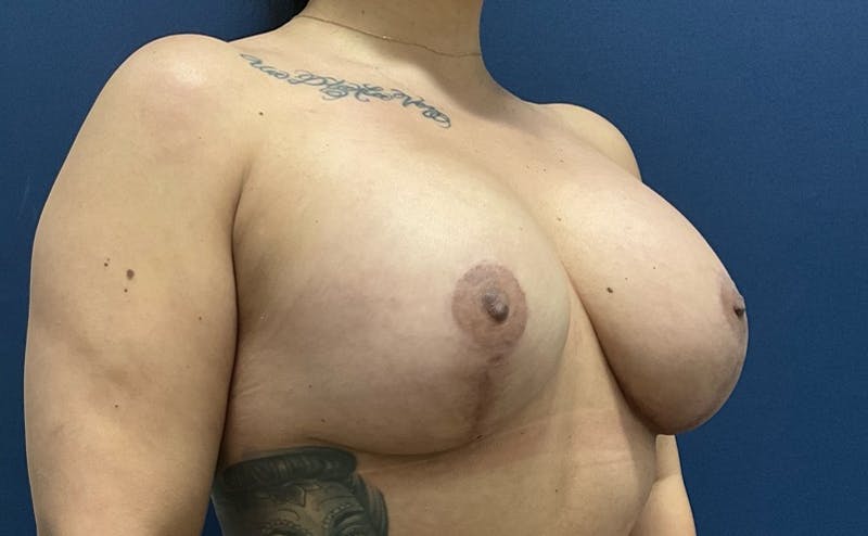  Breast Lift with Implant Exchange Dr. Booth Before & After Gallery - Patient 319055 - Image 3