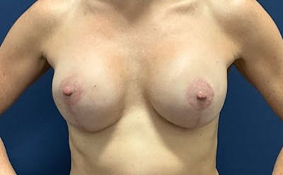 Breast Revision by Dr. Booth Before & After Gallery - Patient 378766 - Image 2