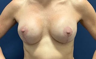 Breast Lift with Implant Exchange Dr. Booth Before & After Gallery - Patient 341105 - Image 2