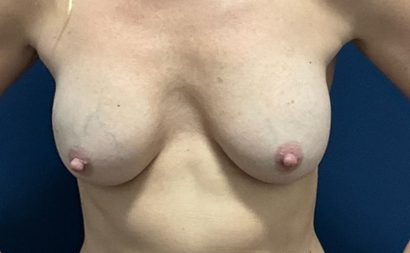 Breast Lift with Implant Exchange Dr. Booth Before & After Gallery - Patient 341105 - Image 1