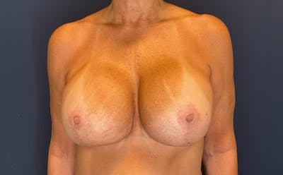 Breast Revision by Dr. Booth Before & After Gallery - Patient 306678 - Image 2