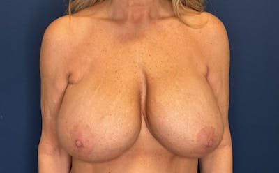 Breast Lift with Implant Exchange Dr. Booth Before & After Gallery - Patient 304491 - Image 1