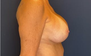 Breast Lift with Implant Exchange Dr. Booth Before & After Gallery - Patient 304491 - Image 4