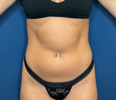 Liposuction by Dr. Booth Before & After Gallery - Patient 293880 - Image 1