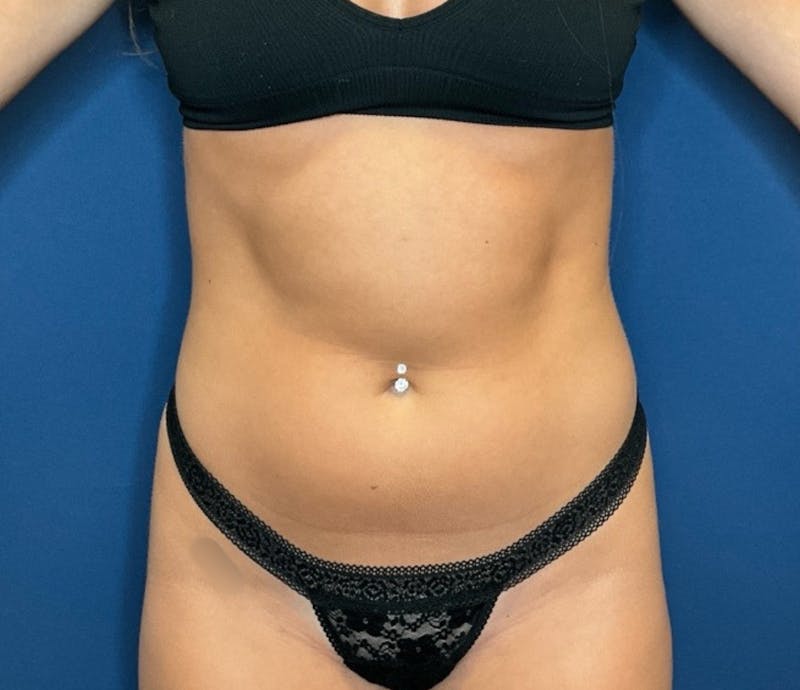 Liposuction by Dr. Booth Before & After Gallery - Patient 293880 - Image 1