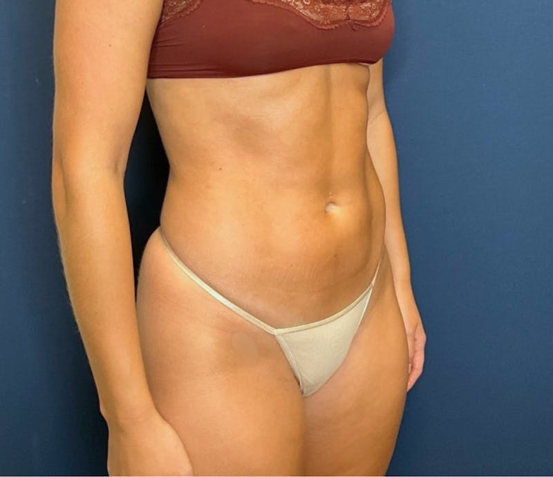 Liposuction by Dr. Booth Before & After Gallery - Patient 293880 - Image 4