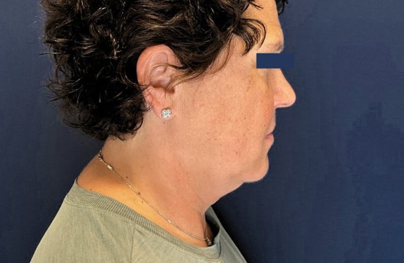 MyEllevate by Dr. Booth Before & After Gallery - Patient 689806 - Image 1