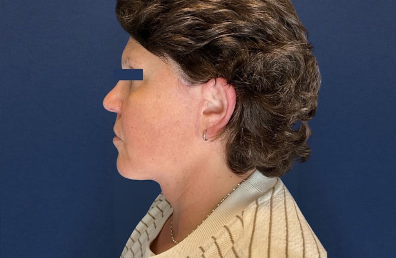 MyEllevate by Dr. Booth Before & After Gallery - Patient 689806 - Image 6