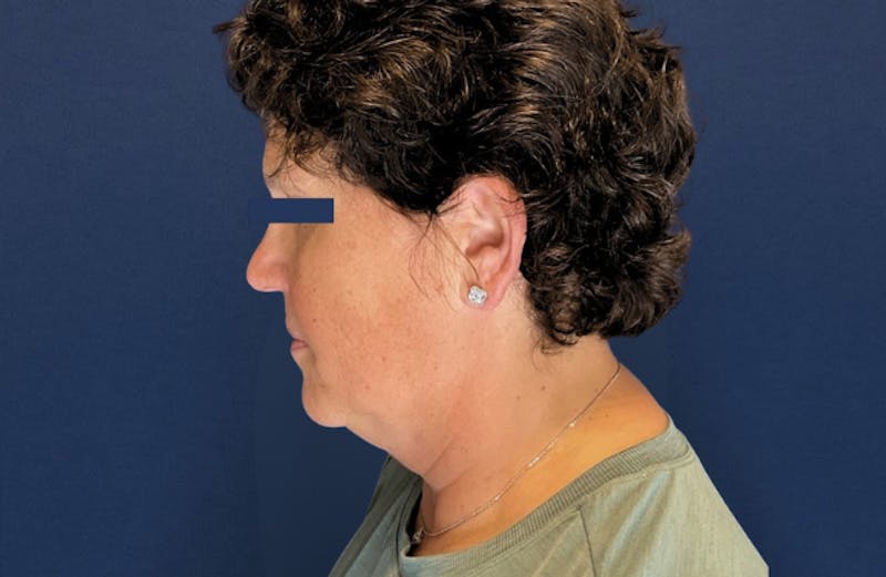 MyEllevate by Dr. Booth Before & After Gallery - Patient 689806 - Image 5