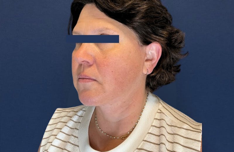 MyEllevate by Dr. Booth Before & After Gallery - Patient 689806 - Image 8