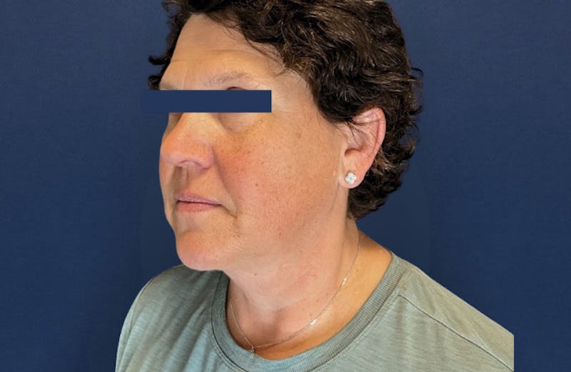 MyEllevate by Dr. Booth Before & After Gallery - Patient 689806 - Image 7