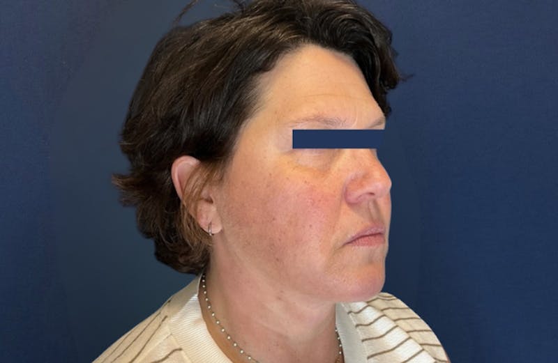 MyEllevate by Dr. Booth Before & After Gallery - Patient 689806 - Image 4