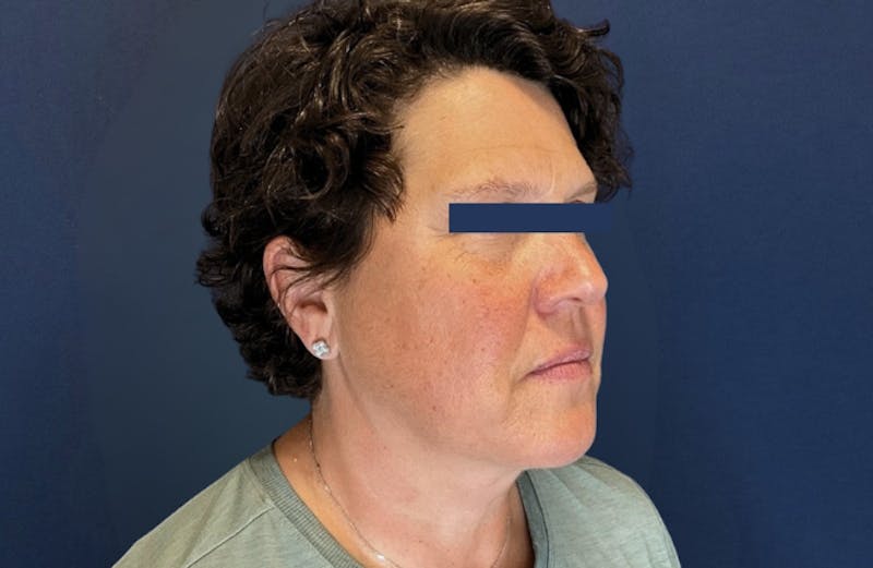 MyEllevate by Dr. Booth Before & After Gallery - Patient 689806 - Image 3