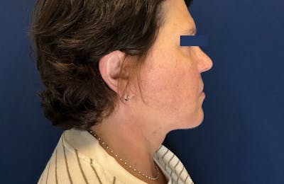 MyEllevate by Dr. Booth Before & After Gallery - Patient 689806 - Image 2