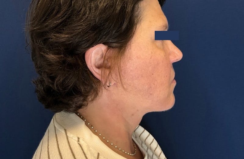 MyEllevate by Dr. Booth Before & After Gallery - Patient 689806 - Image 2