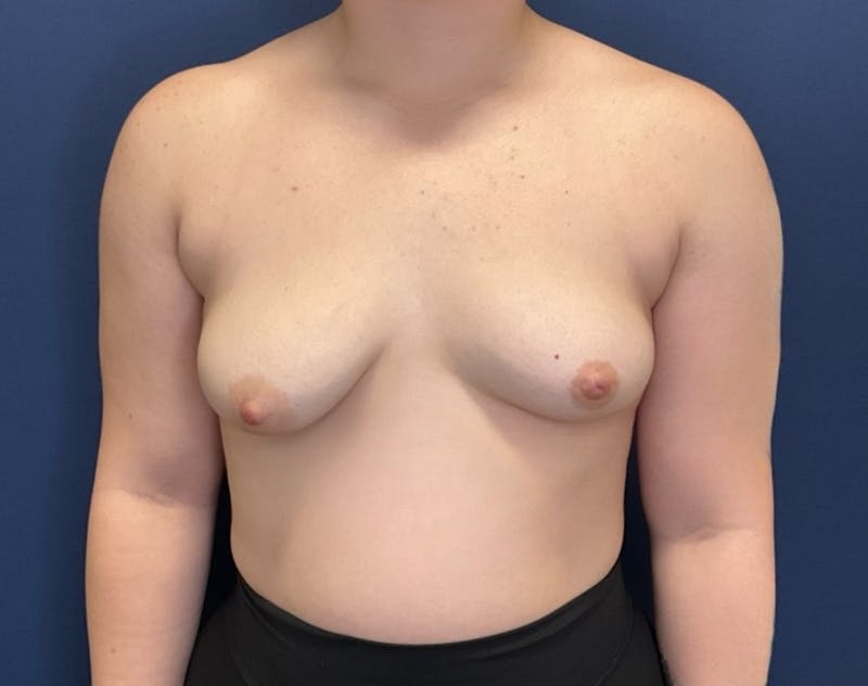 Breast Augmentation by Dr. Booth Before & After Gallery - Patient 162519 - Image 1