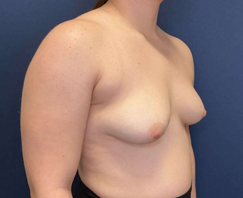Breast Augmentation by Dr. Booth Before & After Gallery - Patient 162519 - Image 3