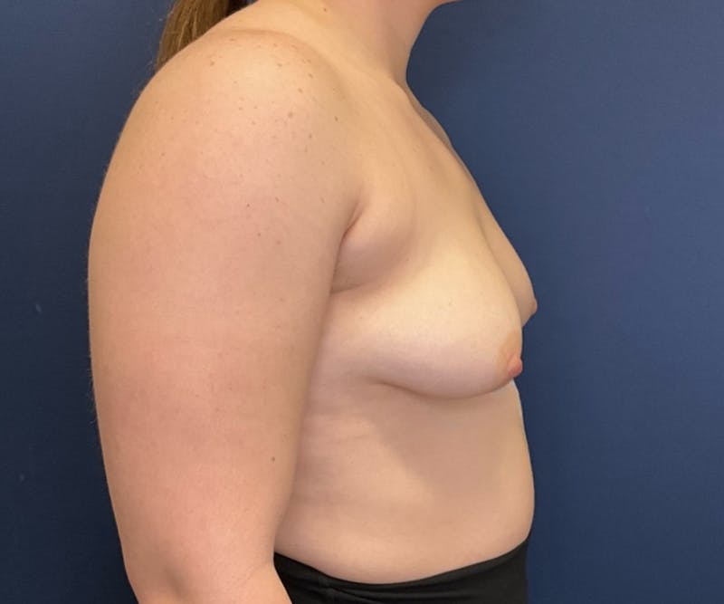Breast Augmentation by Dr. Booth Before & After Gallery - Patient 162519 - Image 5