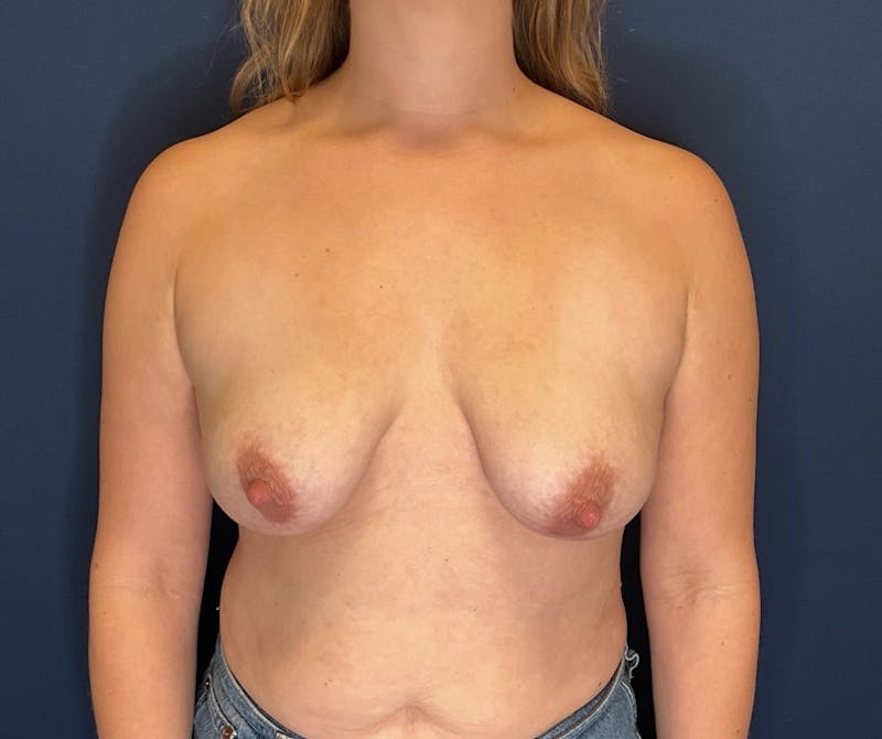  Breast Lift with Augmentation Dr. Booth Before & After Gallery - Patient 370669 - Image 1