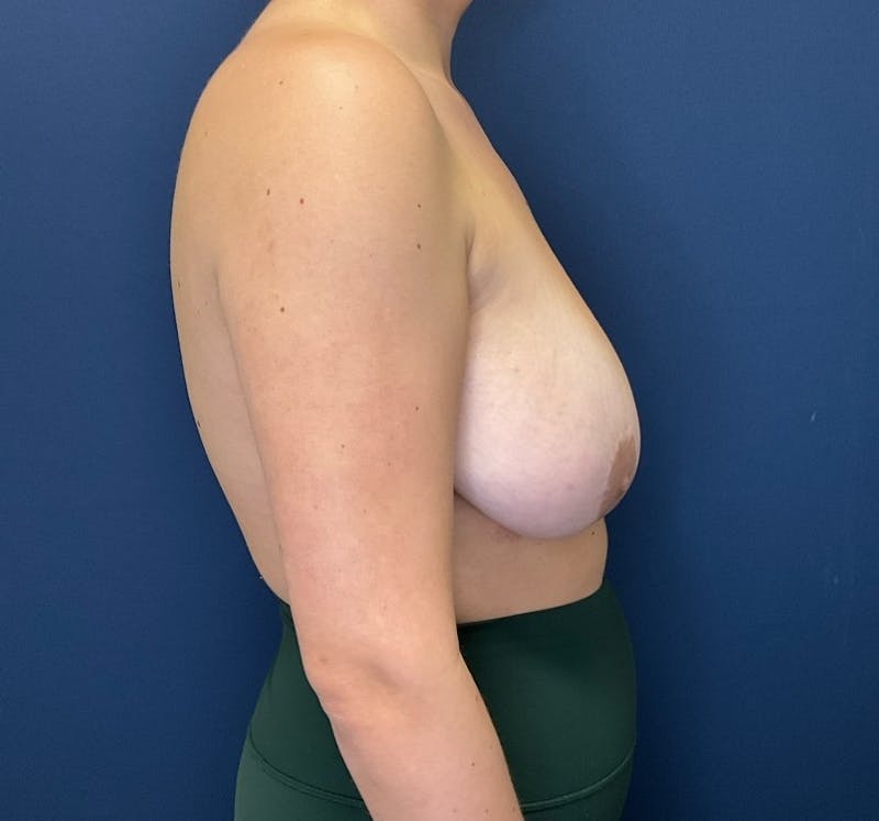 Breast Lift by Dr. Booth Before & After Gallery - Patient 289957 - Image 5
