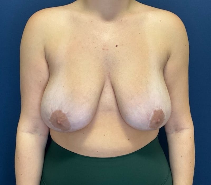 Breast Lift by Dr. Booth Before & After Gallery - Patient 289957 - Image 1