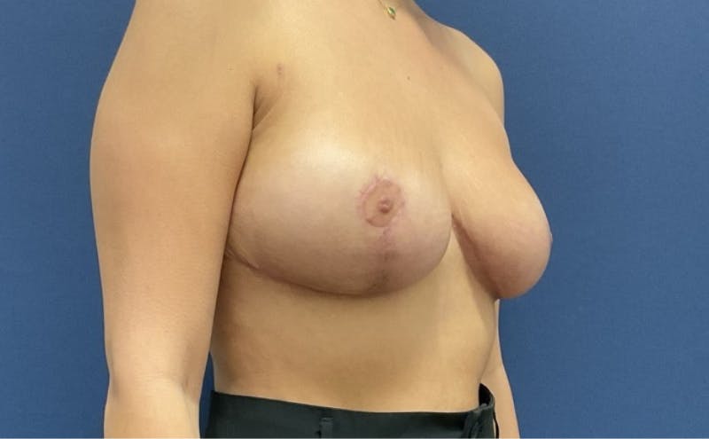 Breast Reduction by Dr. Booth Before & After Gallery - Patient 328615 - Image 4