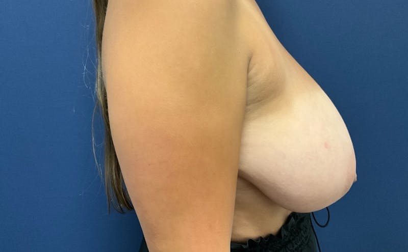 Breast Reduction by Dr. Booth Before & After Gallery - Patient 328615 - Image 5