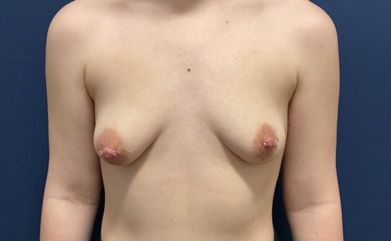 Breast Augmentation by Dr. Booth Before & After Gallery - Patient 365697 - Image 1