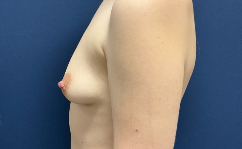 Breast Augmentation by Dr. Booth Before & After Gallery - Patient 365697 - Image 3