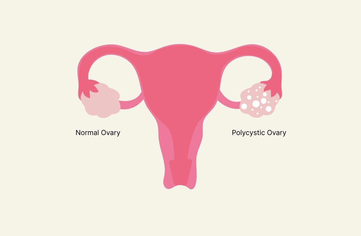 Normal ovary and polycystic ovary.