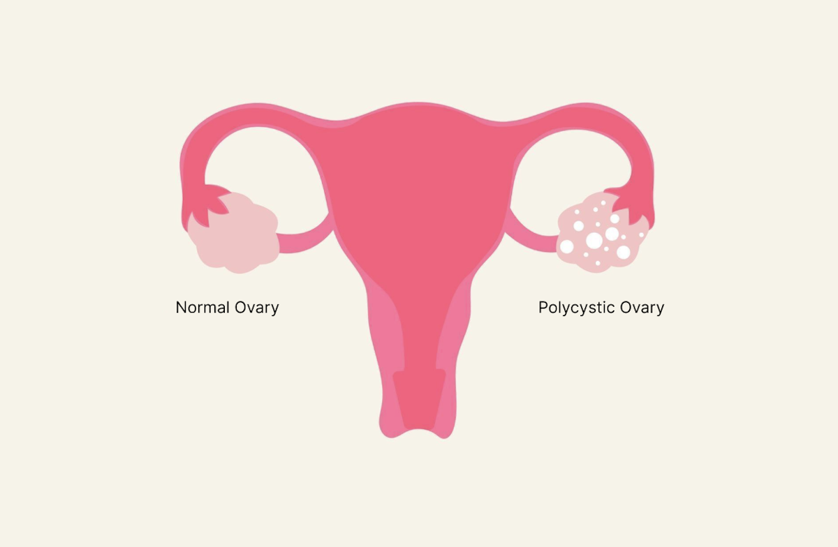 PCOS and Fertility: Everything You Need to Know
