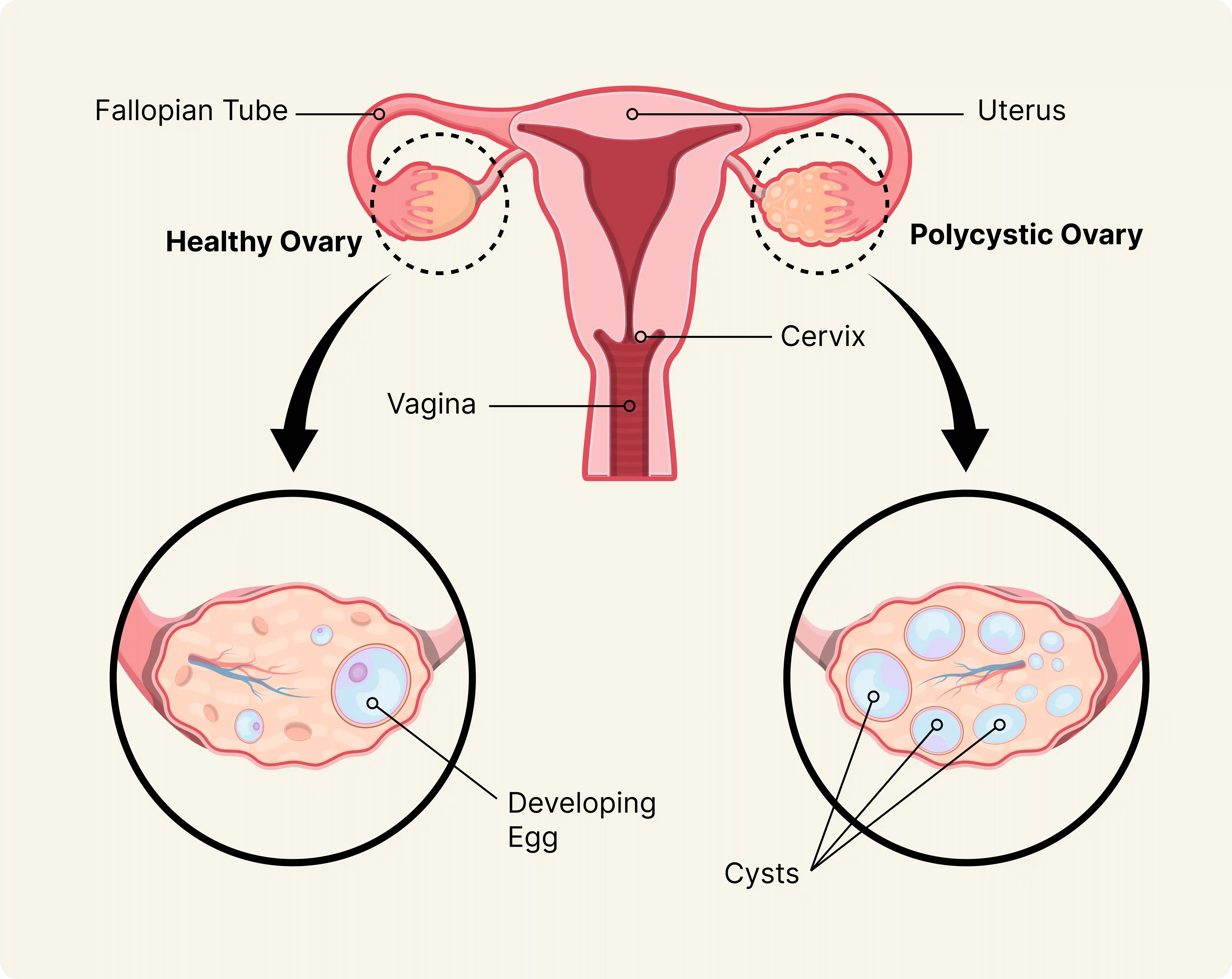 A normal ovary and a polycystic ovary.