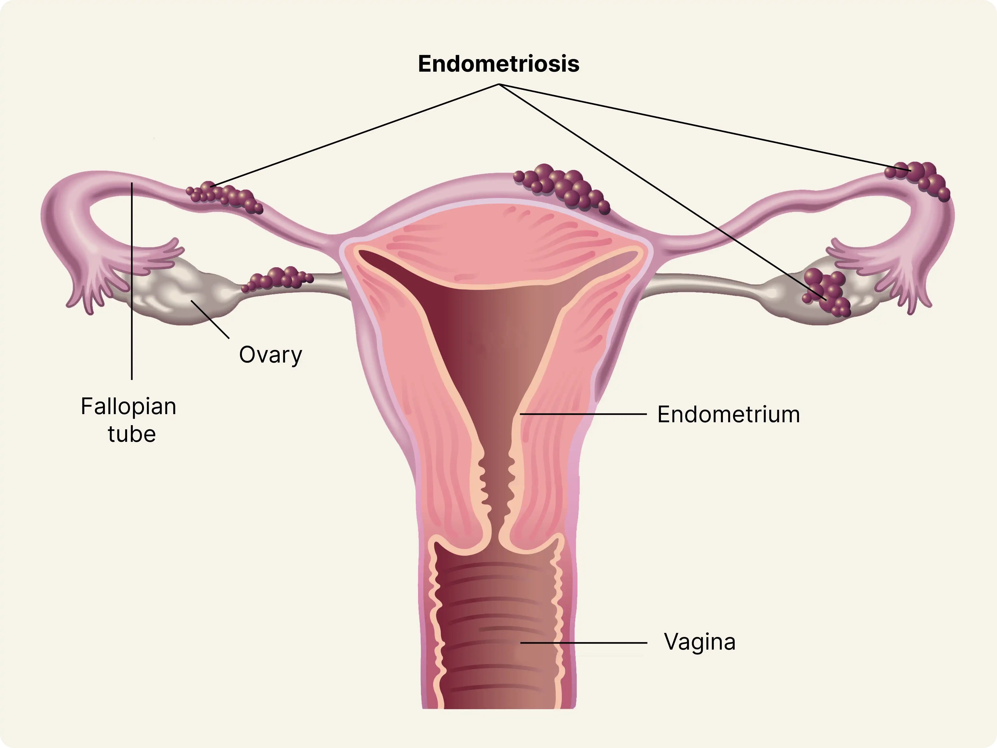 Endometriosis diagram.