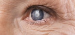 Cataract Surgery image