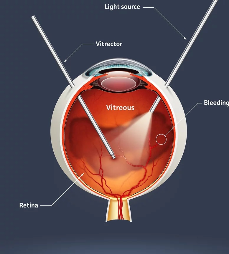 Retinal Surgery Vitrectomy image