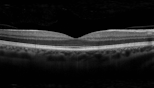 Macula Treatments image