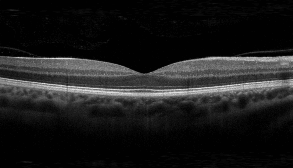 Macula Treatments image